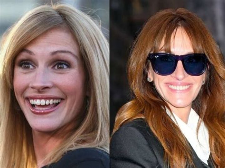 Perfect celebrity teeth Julia Roberts smile with veneers. More info on
