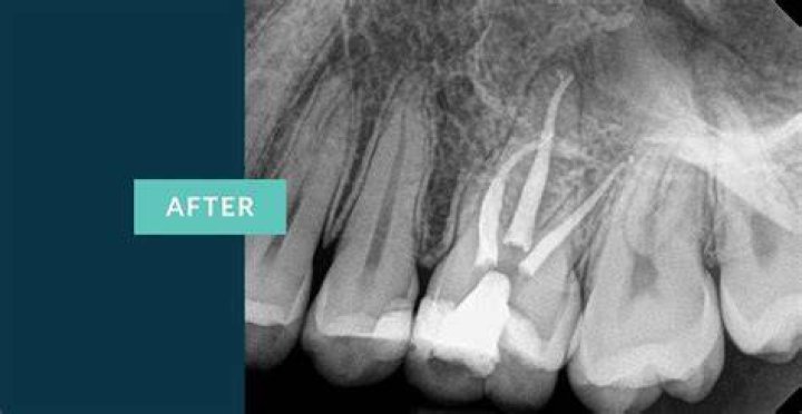 RCT Upper Molar: Comprehensive Guide to Root Canal Treatment for Upper Molars